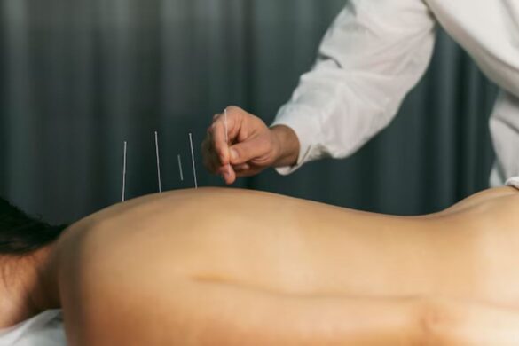 Acupuncture for Headaches: A Natural Remedy for Lasting Relief